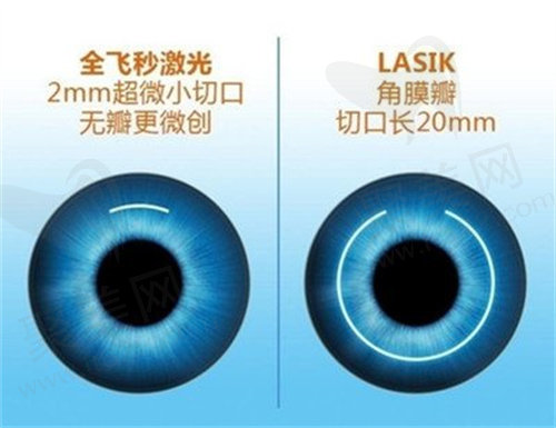 近视手术