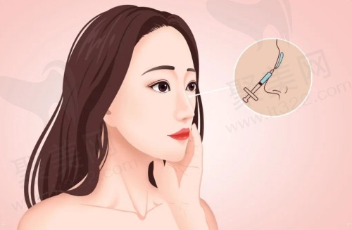 上海隆鼻手术要多少钱
