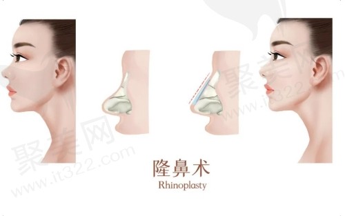 上海做隆鼻比较好的医生