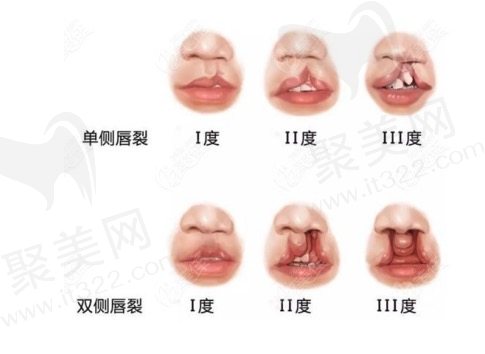 在线预设余文林医生唇腭裂