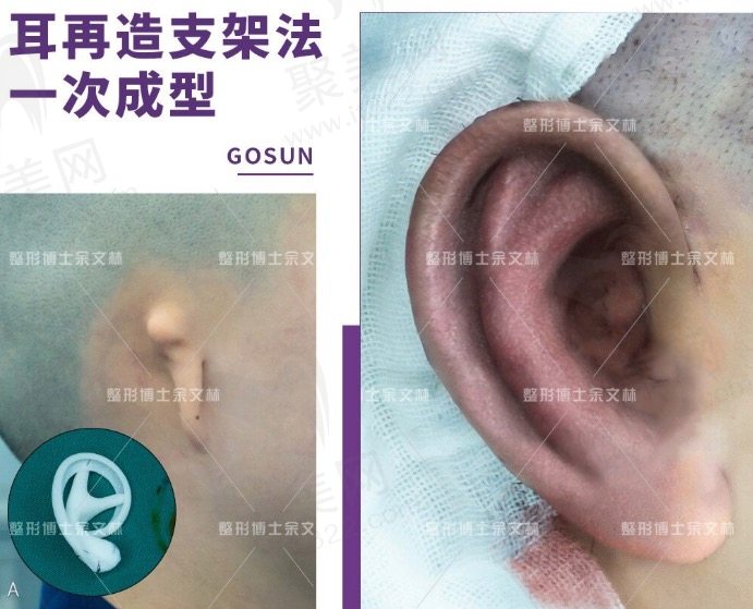 余文林做耳再造技术好不好