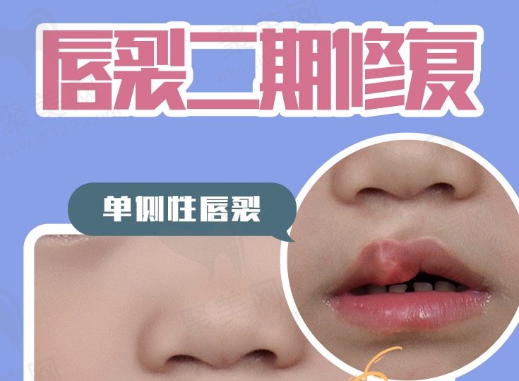 广州高尚余文林医生唇裂技术好不好？
