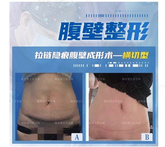 广州高尚余文林医生腹壁整形技术怎么样