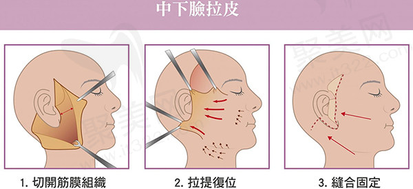 广州拉皮手术哪个医生好