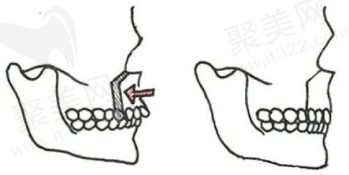 广州做正颌手术好的医院医生