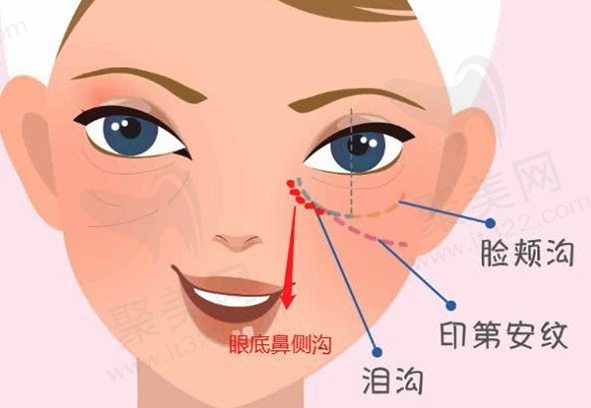 脸上有猫咪纹怎么形成的？