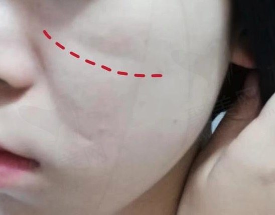 去除猫咪纹的方法有哪些？