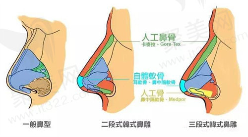 隆鼻手术