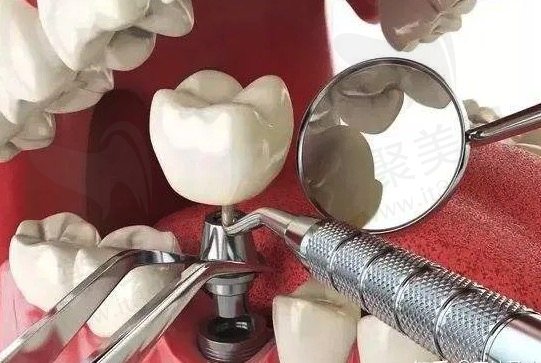 武汉口腔医院种植牙多少钱一颗？