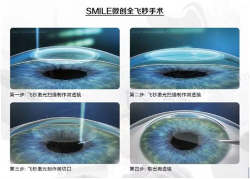近视手术