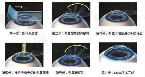 近视手术