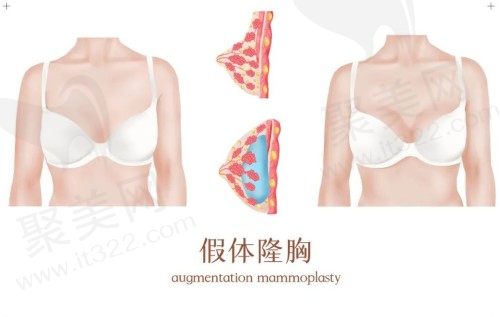 上海美莱汪灏隆胸手术多少钱