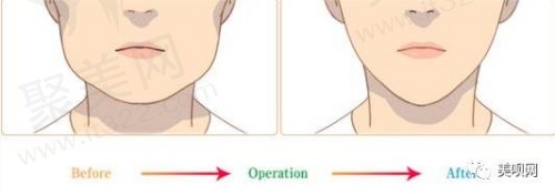 打瘦脸和轮廓提升有什么区别 打瘦脸和轮廓提升有什么区别