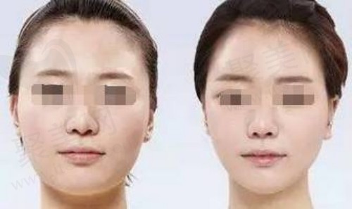 打瘦脸和轮廓提升有什么区别 打瘦脸和轮廓提升有什么区别
