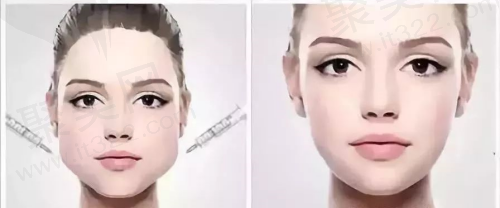 打瘦脸和轮廓提升有什么区别 打瘦脸和轮廓提升有什么区别