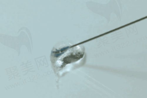 玻尿酸注射总结