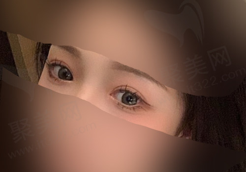术后一个多月变化