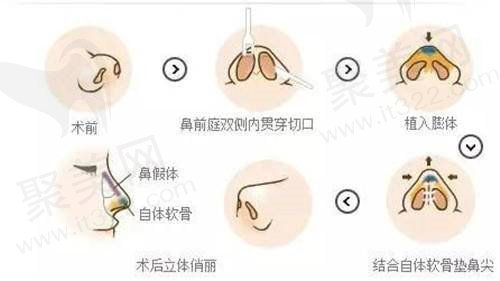 膨体隆鼻