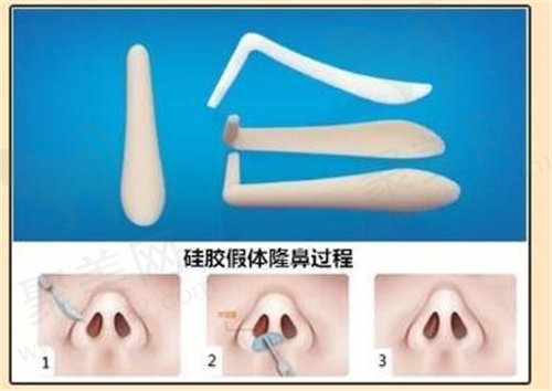 膨体隆鼻