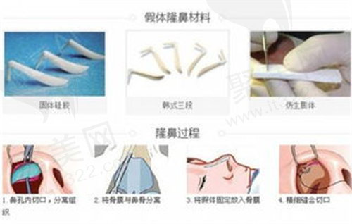 完膨体隆鼻