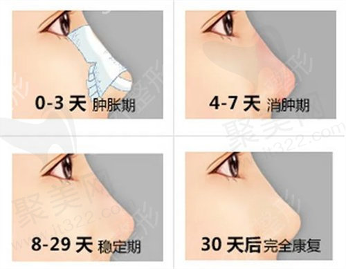 完膨体隆鼻