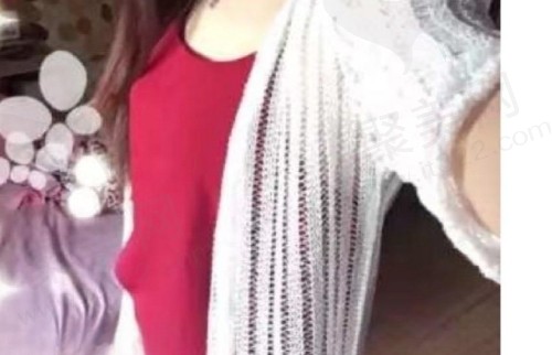 上海艺星陈成假体隆胸真人例子