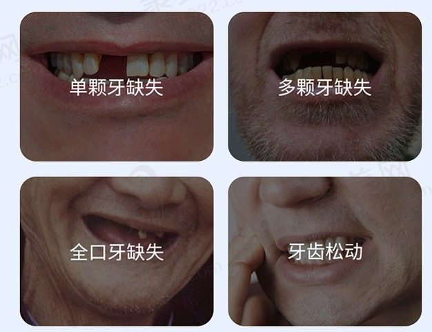 宁波奉化口腔医院诺贝尔种植牙多少钱一颗？