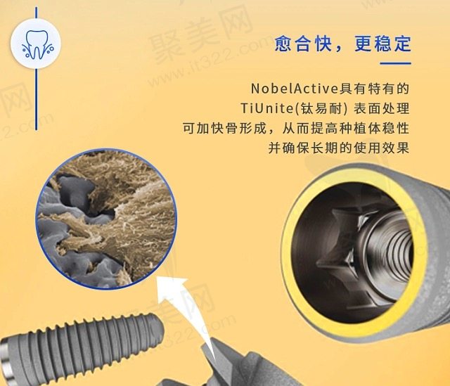 诺贝尔种植牙有什么优势？