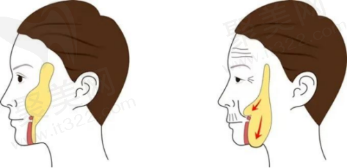 面部拉皮手术大概需要多少钱