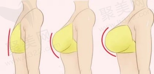 刘伟杰医生隆胸手术口碑好不好