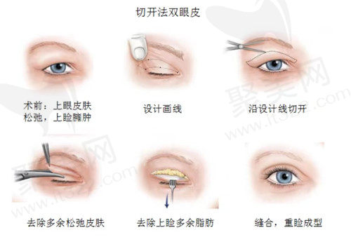 双眼皮手术过程
