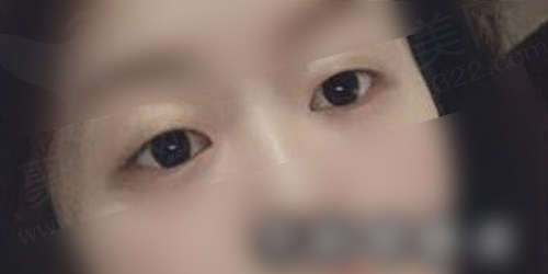 术前眼部状况