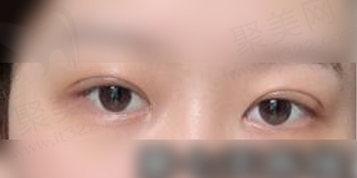 术后一周情况