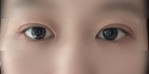 术后一个月