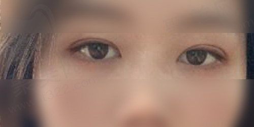 术后一个半月后