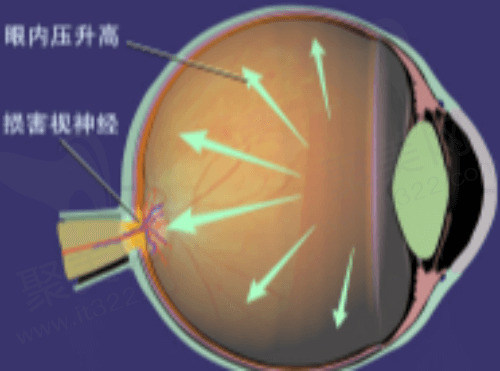 青光眼的表现