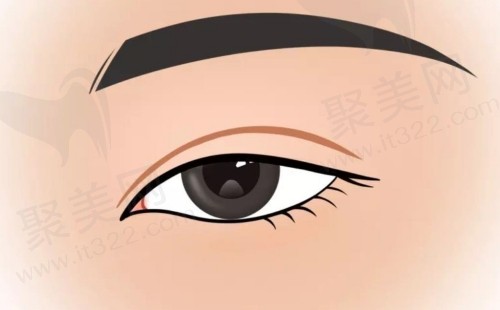 朱迪医生割双眼皮怎么样