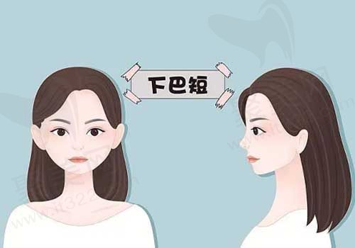 短下巴