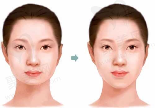 短下巴与正常下巴对比