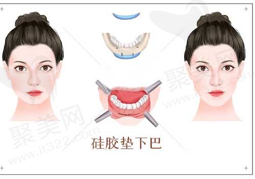 硅胶垫下巴
