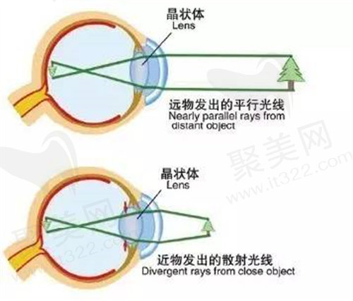 近视手术