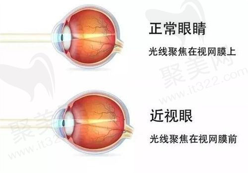 近视手术
