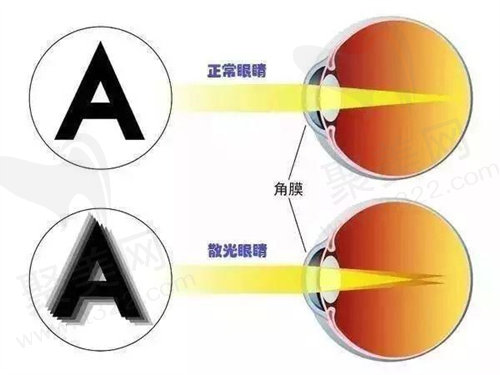 近视手术
