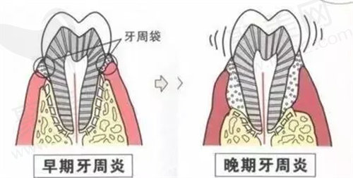 牙龈翻瓣术