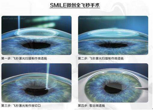 全飞秒激光手术