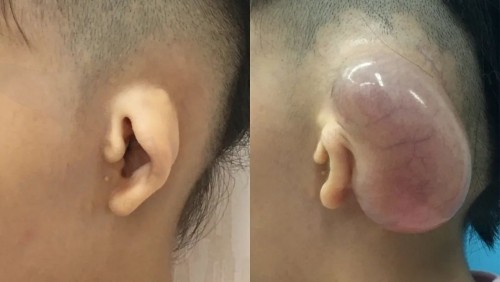 康春雨医生做小耳再造技术好