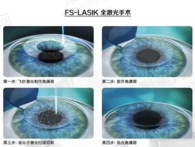 激光矫正近视眼手术的原理是什么?