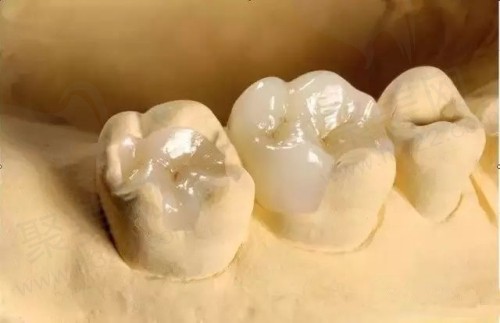 美学树脂补牙多少钱一颗