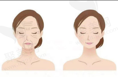 热玛吉和超声炮哪个提升<span style=