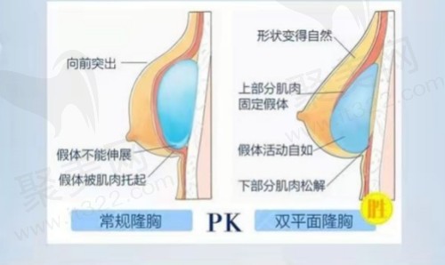 殷初阳医生胸部整形五大优势